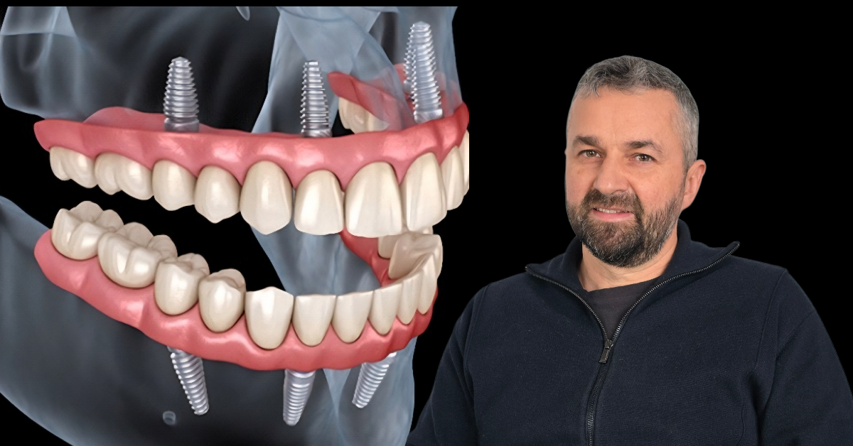 Dinți ficși la Clinica ImplantFix